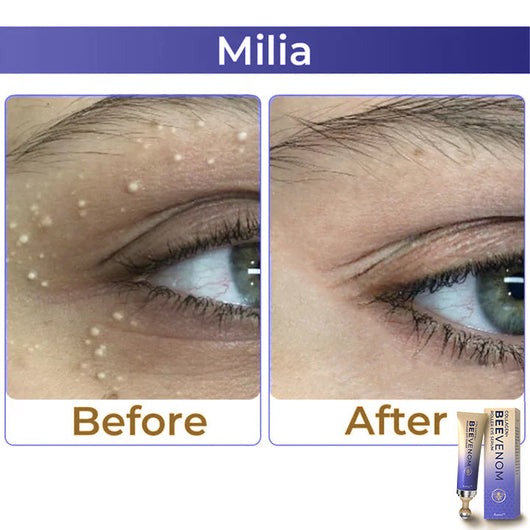 ✨ flysmus™ Collagen+ Bee Venom Roller Eye Cream 🇦🇺 Dermatologist Approved