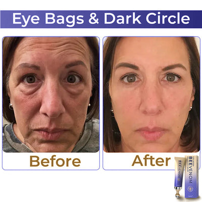 ✨ flysmus™ Collagen+ Bee Venom Roller Eye Cream 🇦🇺 Dermatologist Approved